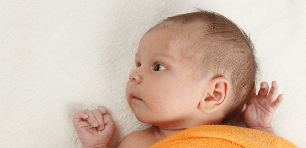 Ini Dia Cara Merawat Kulit Bayi saat Muncul Ruam Susu